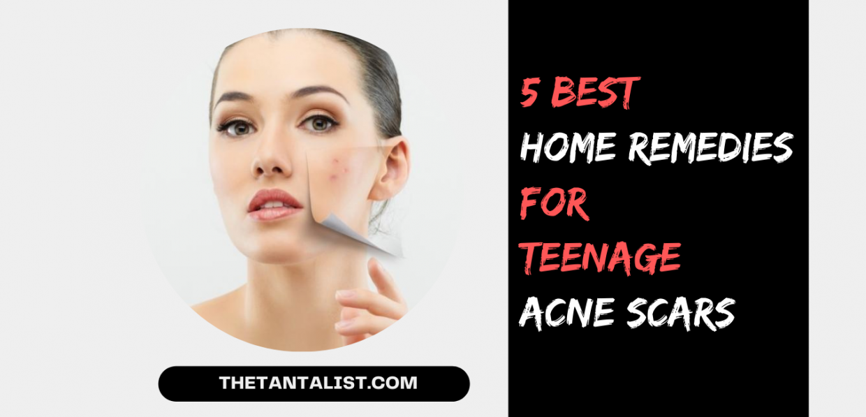 5 Best Super Effective Home Remedies for Teenage Acne Scars 2022 The