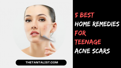 5 Best Super Effective Home Remedies for Teenage Acne Scars